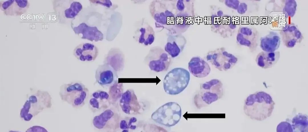 兩名幼童感染“食腦蟲(chóng)”去世！緊急提醒→